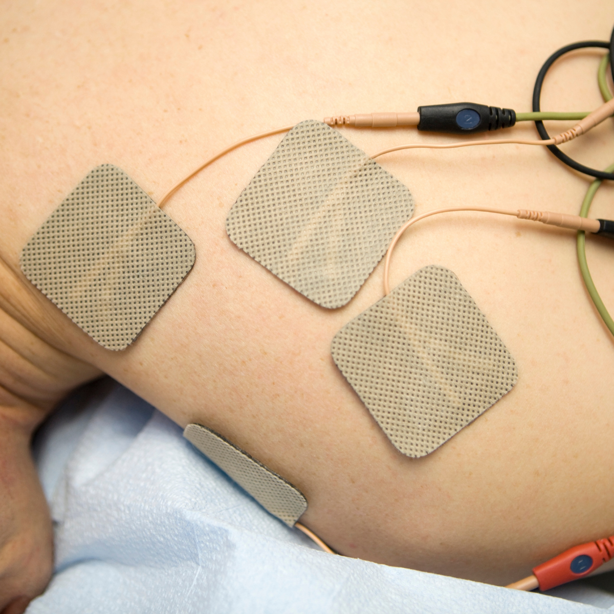 Qué es la electroestimulación y para qué sirve en fisioterapia